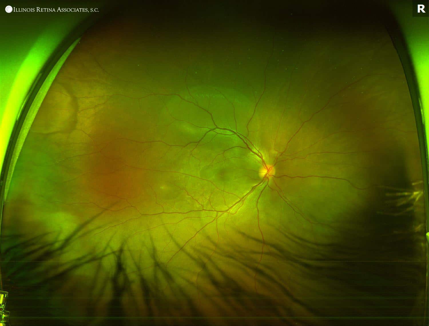 Vogt Koyanagi Harada Disease Vkh December Illinois Retina