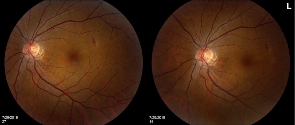 Acute Macular Neuroretinitis – August 2019 | Illinois Retina Associates ...