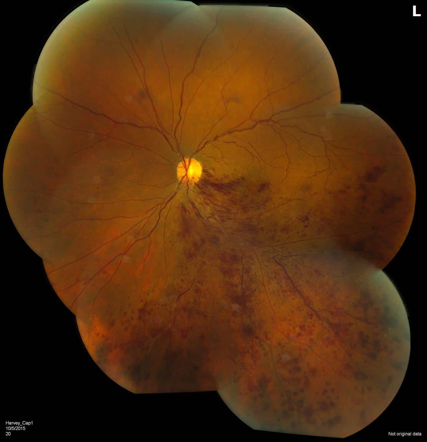 Branch Retinal Vein Occlusion – November 2020 