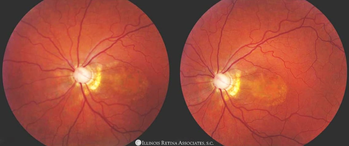 Chorioretinal Colobomas – February, 2022 | Illinois Retina Associates