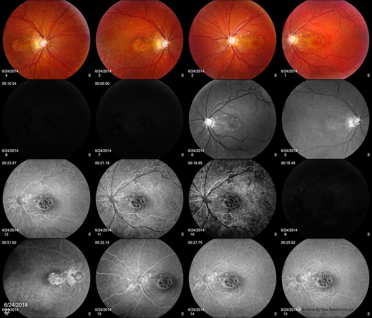 Chorioretinal Colobomas – February, 2022 | Illinois Retina Associates