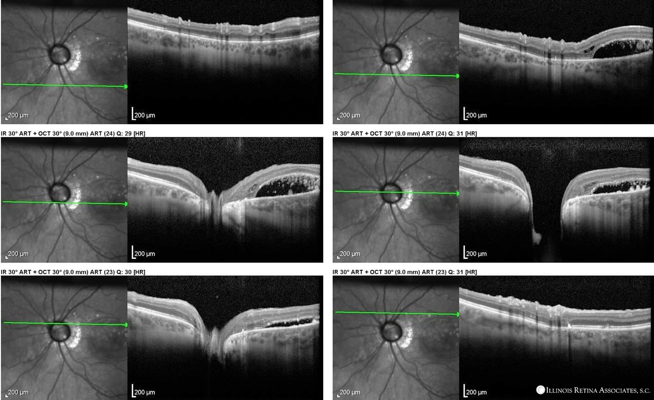 Chorioretinal Colobomas – February, 2022 