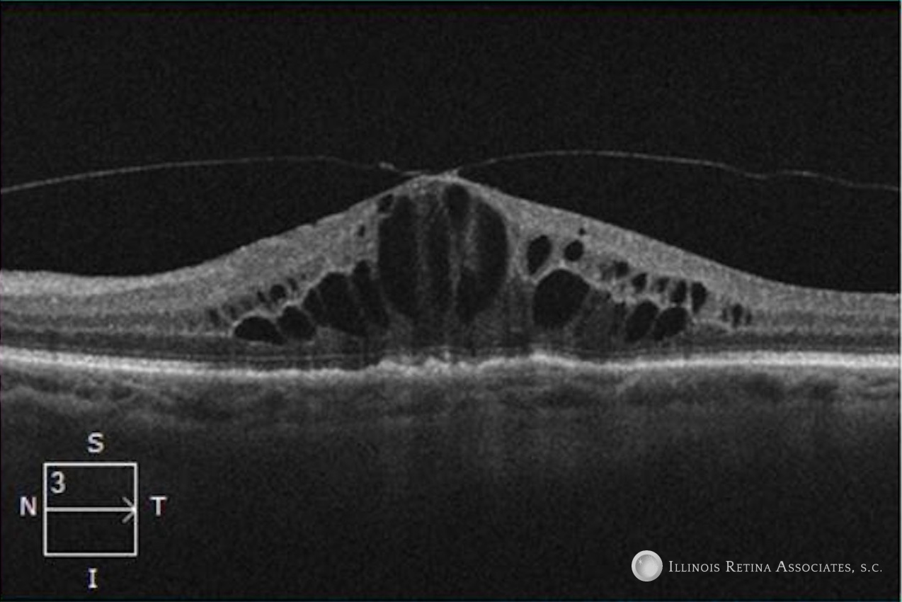 Cystoid Macular Edema (CME) – September, 2022 | Illinois Retina ...