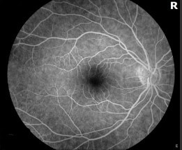 High Altitude Retinopathy – February 2020 | Illinois Retina Associates ...