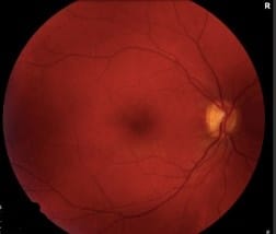 High Altitude Retinopathy – February 2020 | Illinois Retina Associates ...