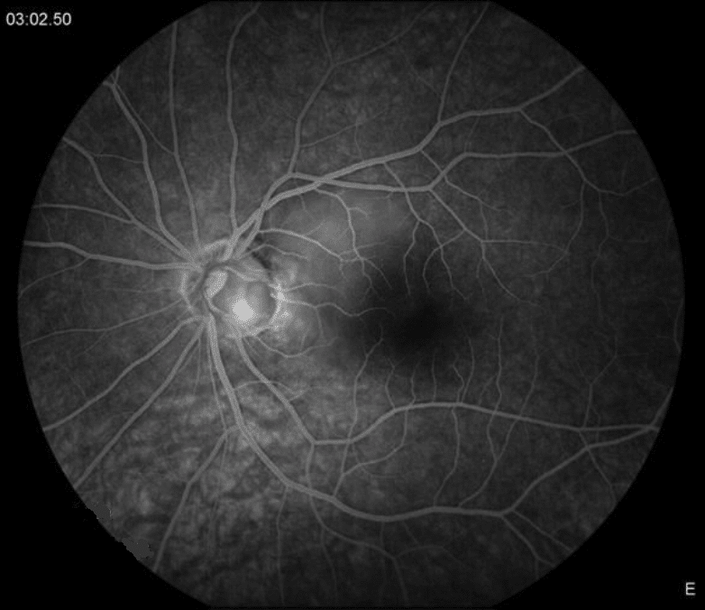 Optic Nerve Pit – February 2019 | Illinois Retina Associates™: Top ...