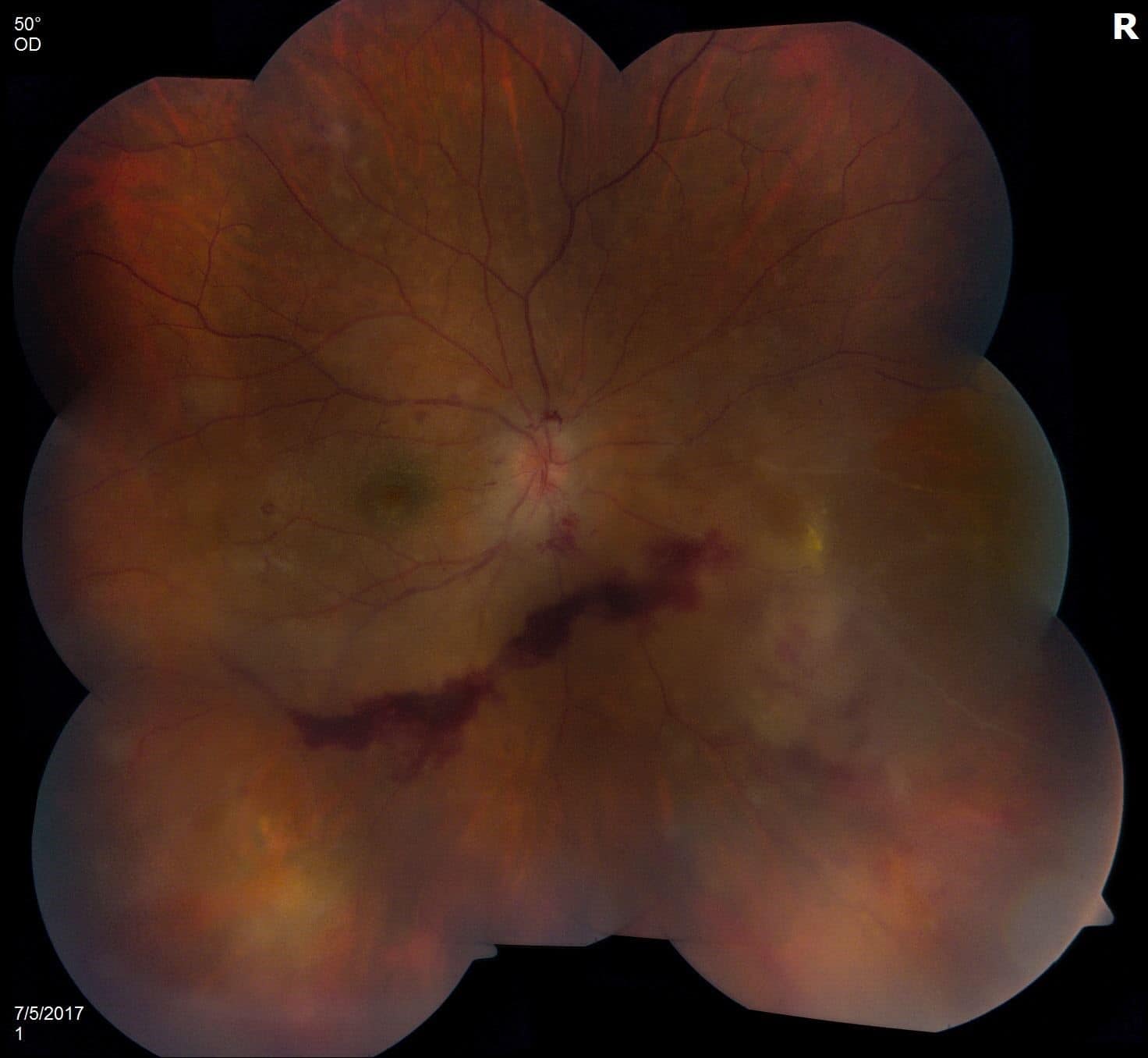 Parry Romberg Syndrome – December 2017 