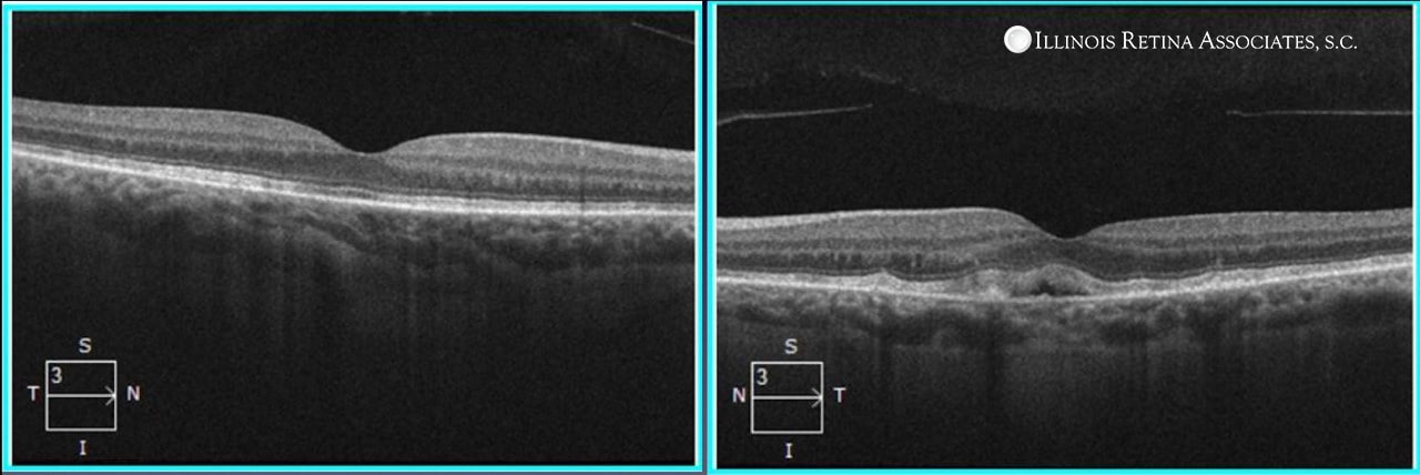 Pentosan Maculopathy – March, 2022 | Illinois Retina Associates™: Top ...