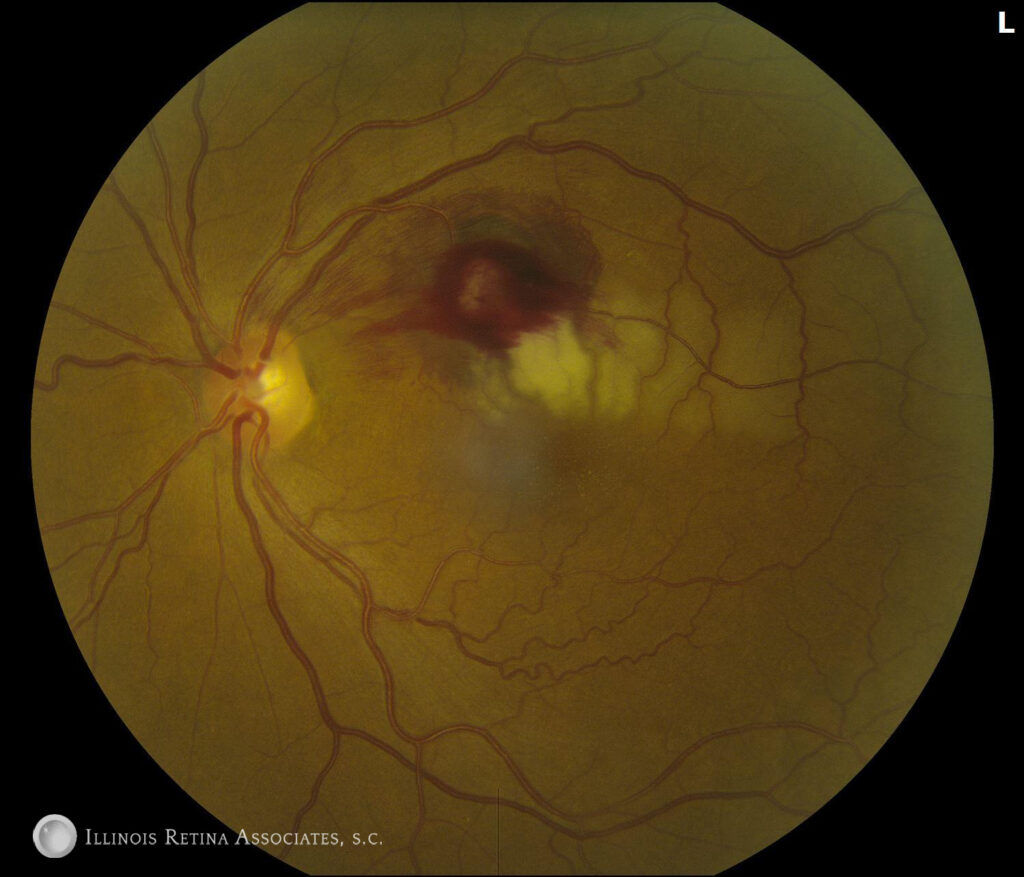 Retinal Artery Macroaneurysyms – November, 2022 | Illinois Retina ...