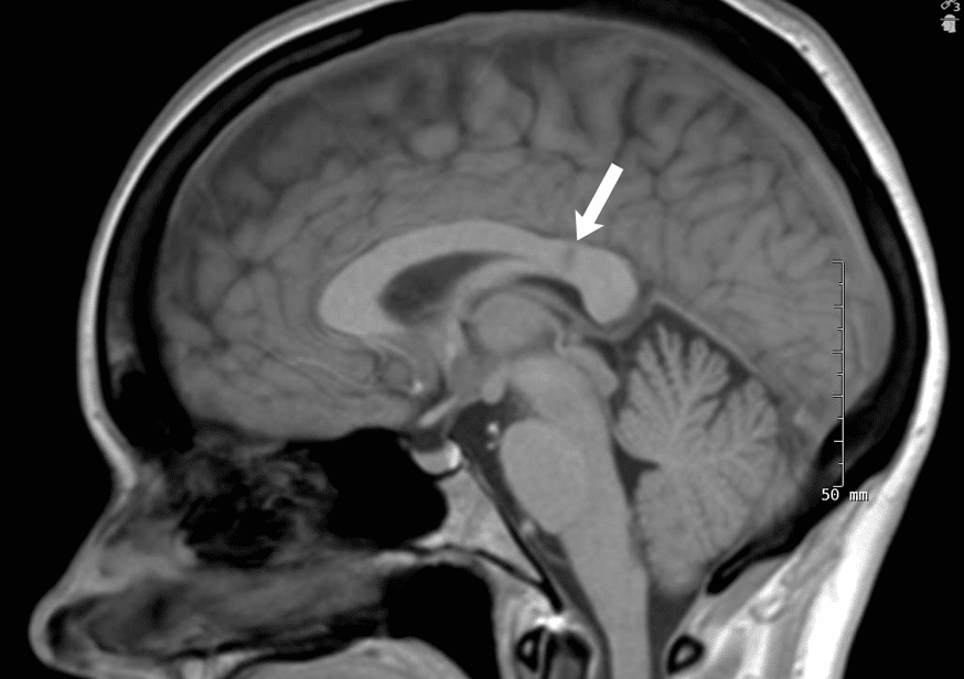 Susac’s Syndrome – September 2017 | Illinois Retina Associates™: Top ...