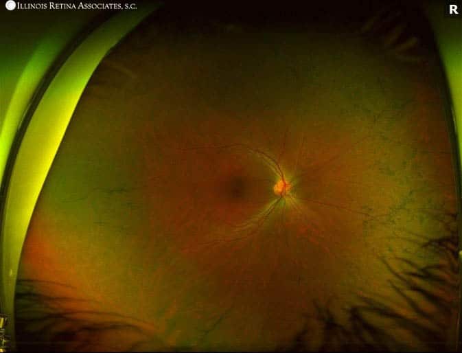 Usher Syndrome – October, 2021 | Illinois Retina Associates™: Top ...