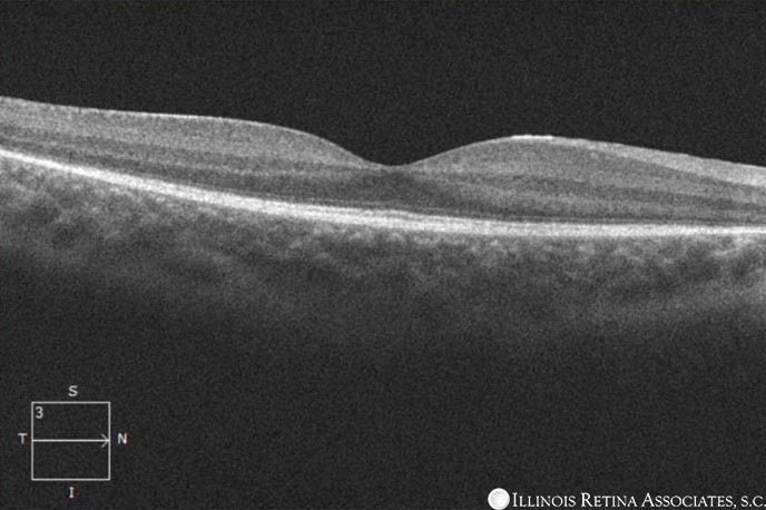 Usher Syndrome – October, 2021 | Illinois Retina Associates™: Top ...